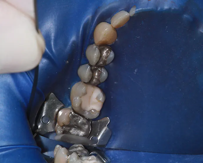 Spanngummi in der Mundhöhle während einer Amalgamsanierung